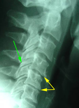 disc degeneration treated at Manchester Chiropractic & Sports Injuries