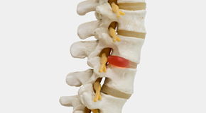 Manchester chiropractic conservative care helps even huge disc herniations go away