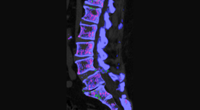 Manchester Chiropractic & Sports Injuries is aware that inflammatory spinal gout is a differential diagnosis to consider for patients who present with back pain and other spine related symptoms.