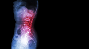 Manchester Chiropractic Care of Spondylolisthesis 