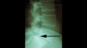 Manchester spondylolisthesis 