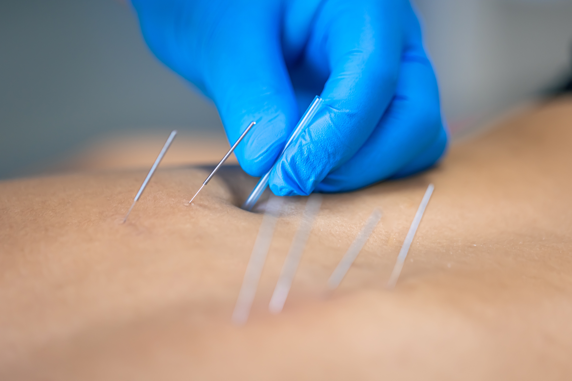 close up photo of acupuncture