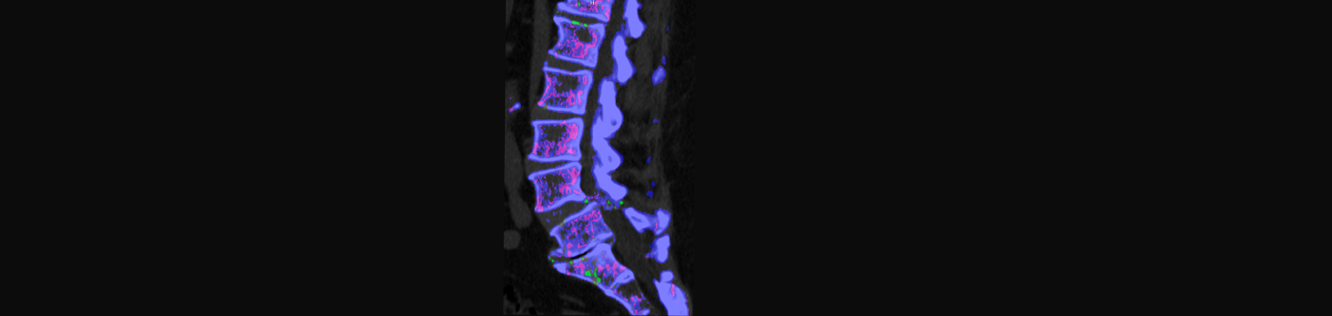 Manchester Chiropractic & Sports Injuries is aware that inflammatory spinal gout is a differential diagnosis to consider for patients who present with back pain and other spine related symptoms.