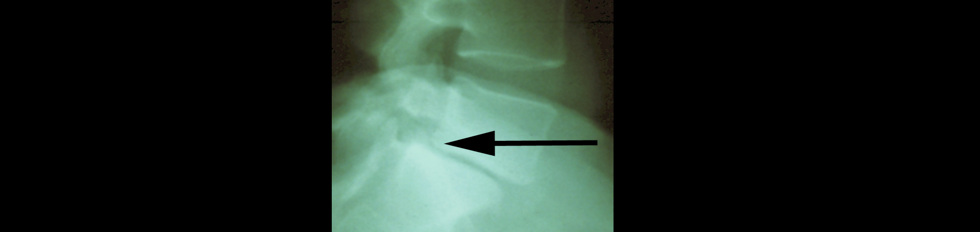 Manchester spondylolisthesis