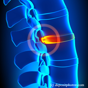 picture of lumbar Manchester disc herniation