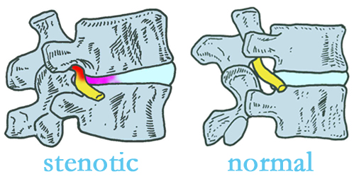 Manchester stenotic and normal spinal discs